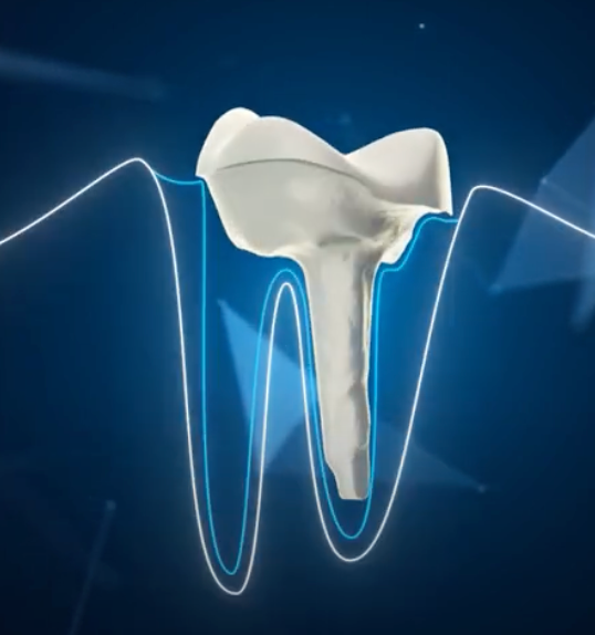 Numerys GF Glass fiber CAD/CAM composite block, pack of 5 pcs