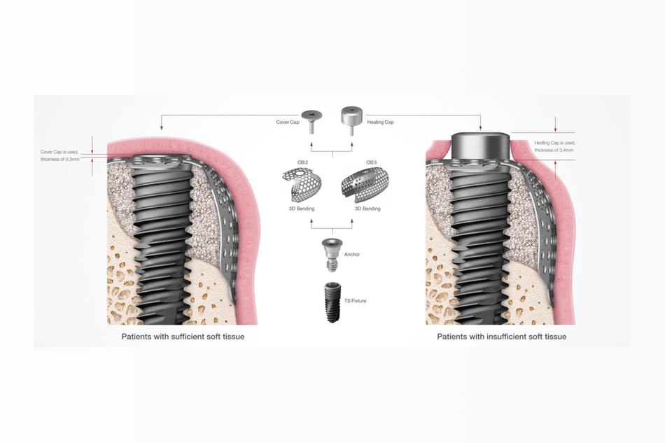 OssBuilder component, healing Cap