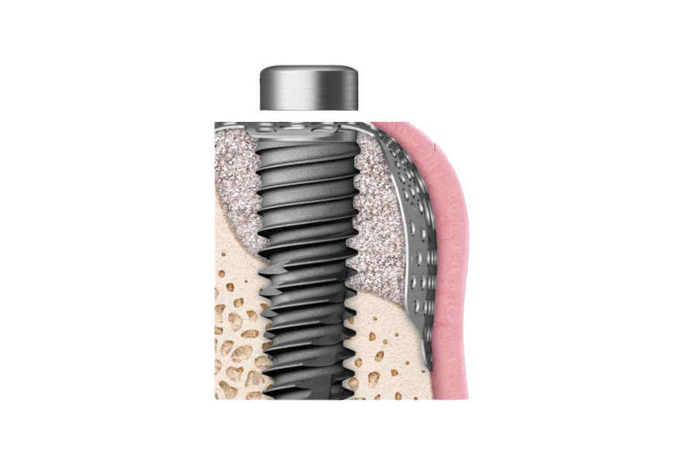 OssBuilder component, healing Cap